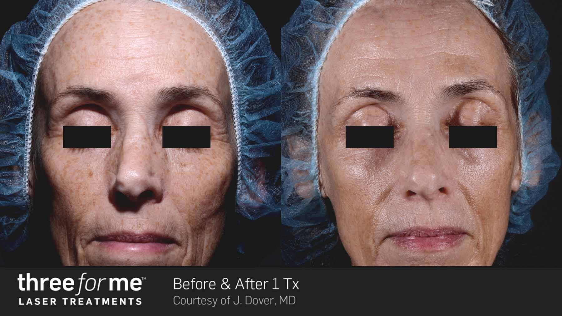 Sun Damage Specialist Lindon, UT Gentle Revive Laser Aesthetics